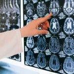 Cách chăm sóc não bộ để tránh suy giảm trí tuệ (dementia)