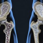 Axit axetic: Liệu pháp kỳ diệu cho bệnh loãng xương