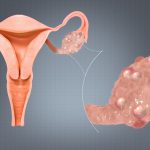 Hội chứng buồng trứng đa nang (PCOS): Nguyên nhân, triệu chứng và điều trị
