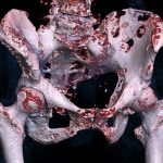 Những điều bạn cần biết về ung thư di căn xương