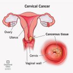 Phòng ngừa ung thư cổ tử cung: Những điều bạn nên biết