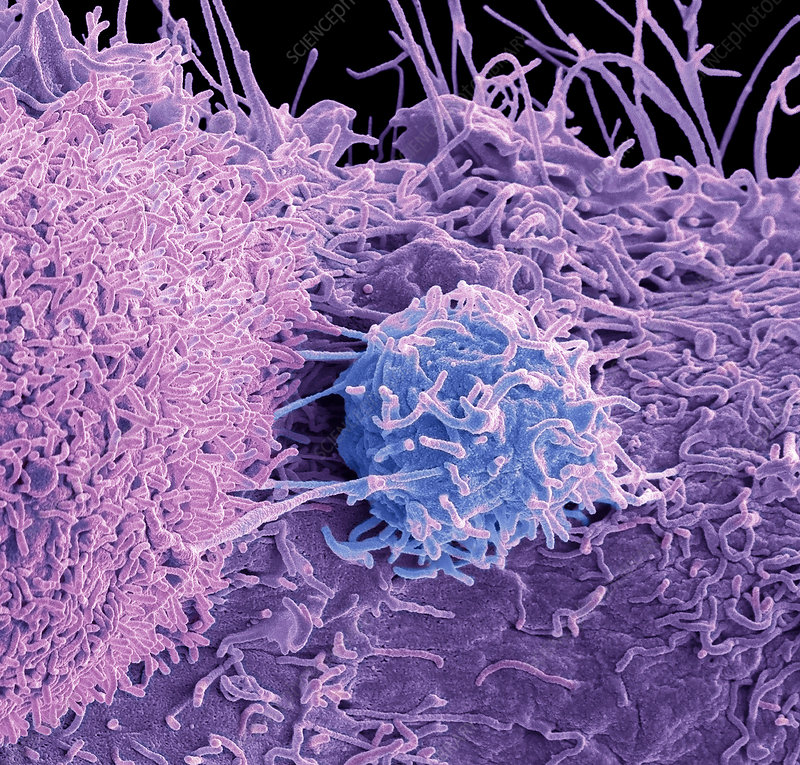 Prostate cancer cells, SEM - Stock Image - F027/0571 - Science Photo ...